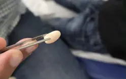 بّة فاصولياء عالقة في أنف طفل ليومين.. وتدخّل طبي ناجح في الناصرة