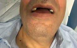 ضربوه وكسروا أسنانه - إعتداء عنصري على سائق مقدسي 