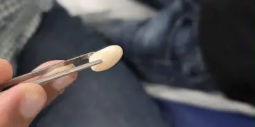 بّة فاصولياء عالقة في أنف طفل ليومين.. وتدخّل طبي ناجح في الناصرة